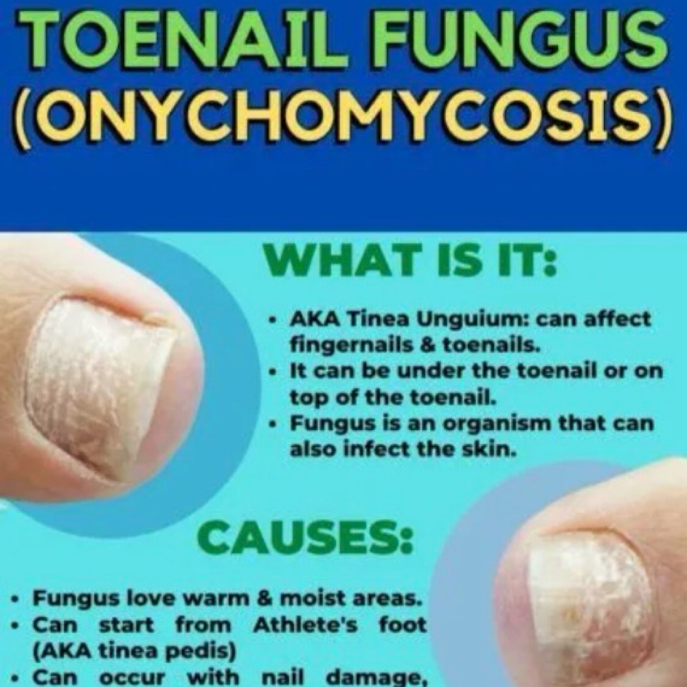 Antifungal Treatment at Patty Nails in McAlpin, FL