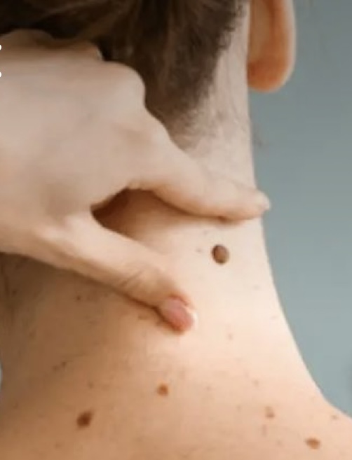 Skin Tag Removal