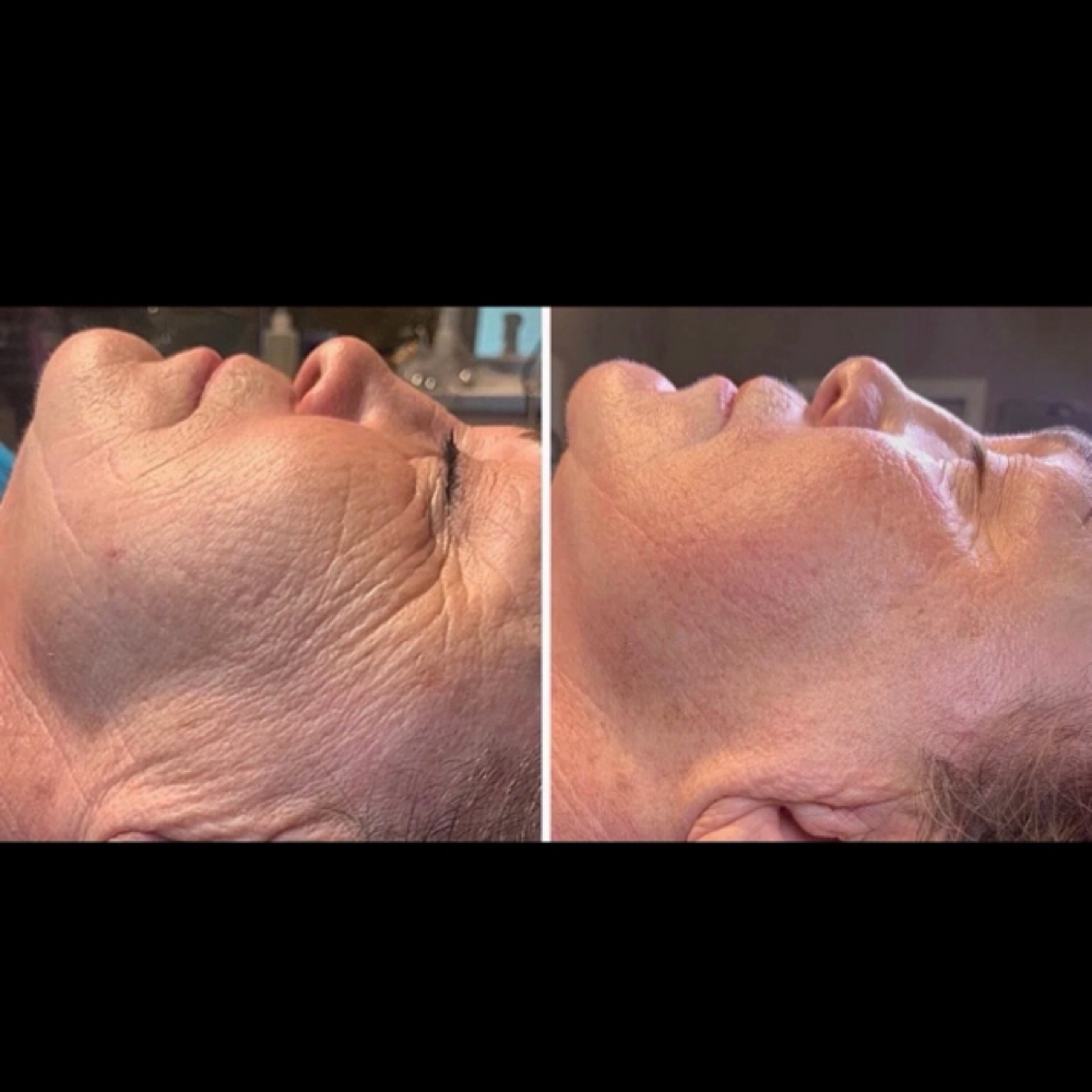 Microneedling Collegen Stimulator at Organic Beauty By Eve in Garden City, NY
