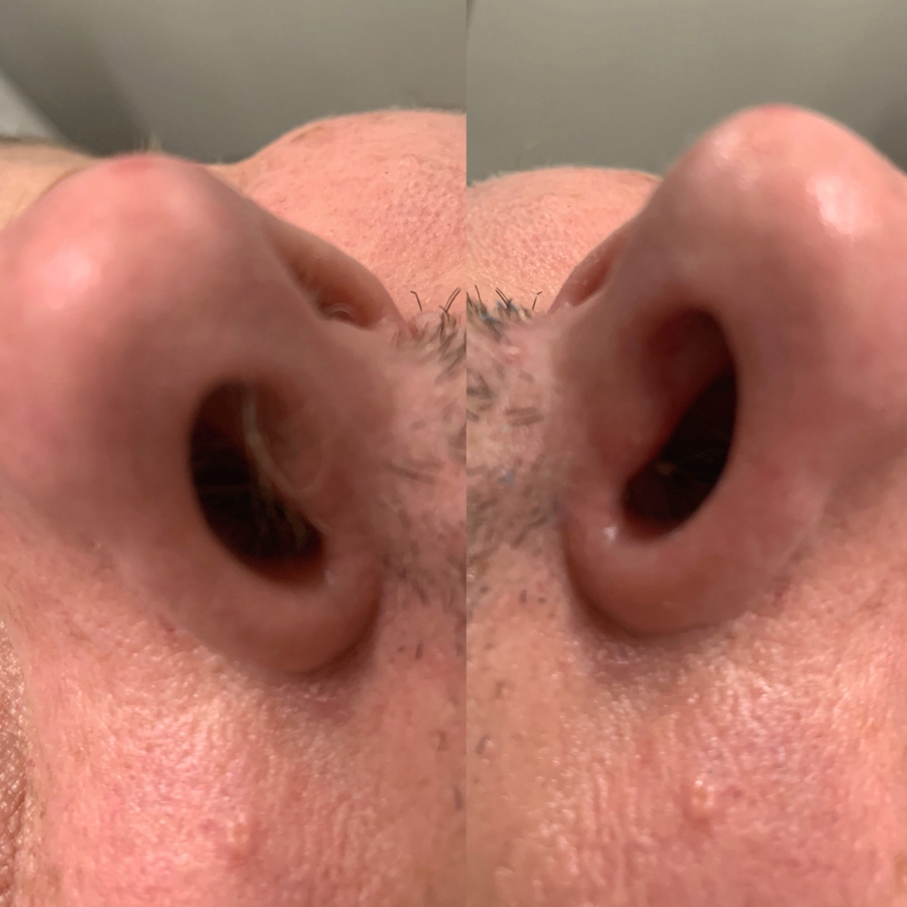 Nose Hair Removal