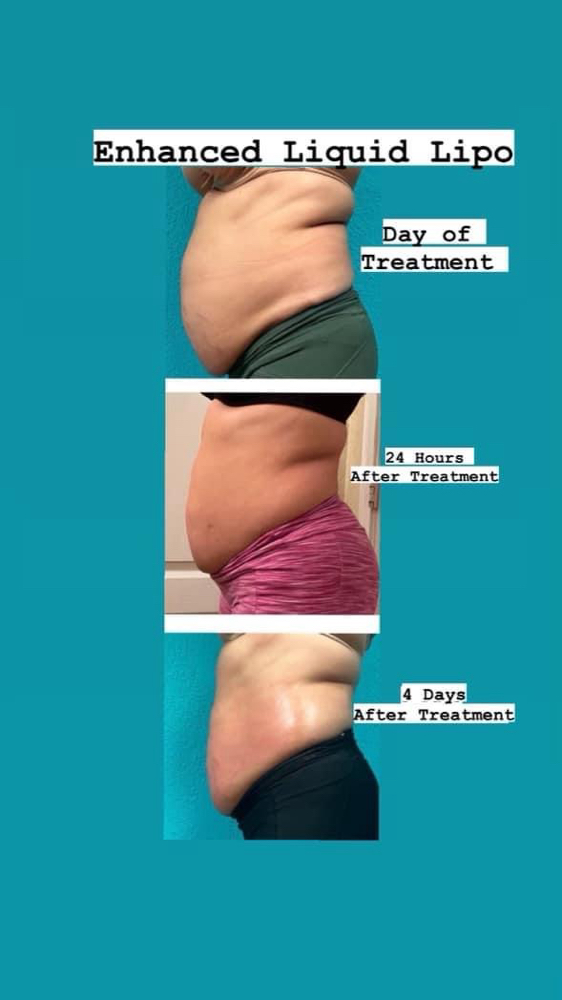Liquid Lipo Fat Dissolver