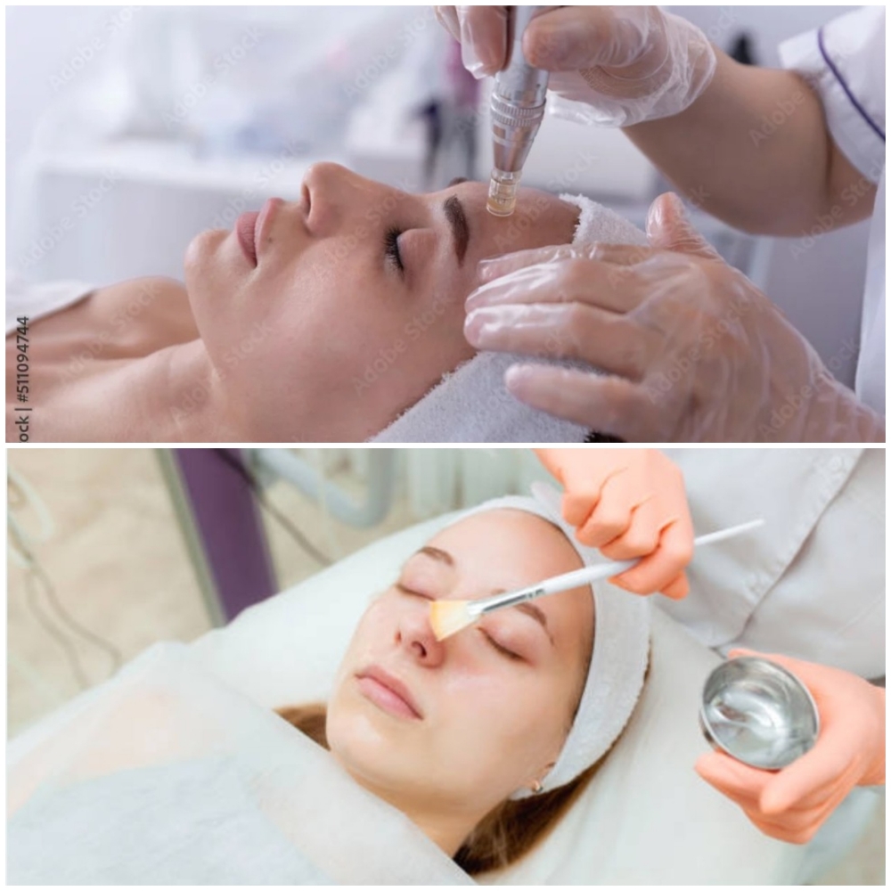 Microneedling & Chemical Peel