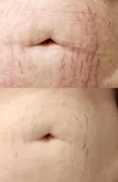 RF for Skin Tightening/Stretchmarks