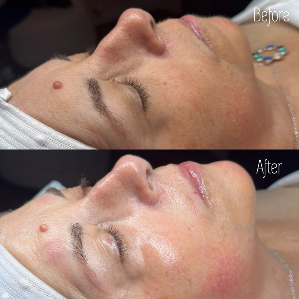 The Renewal at The Skin Lab in Clinton Twp, MI