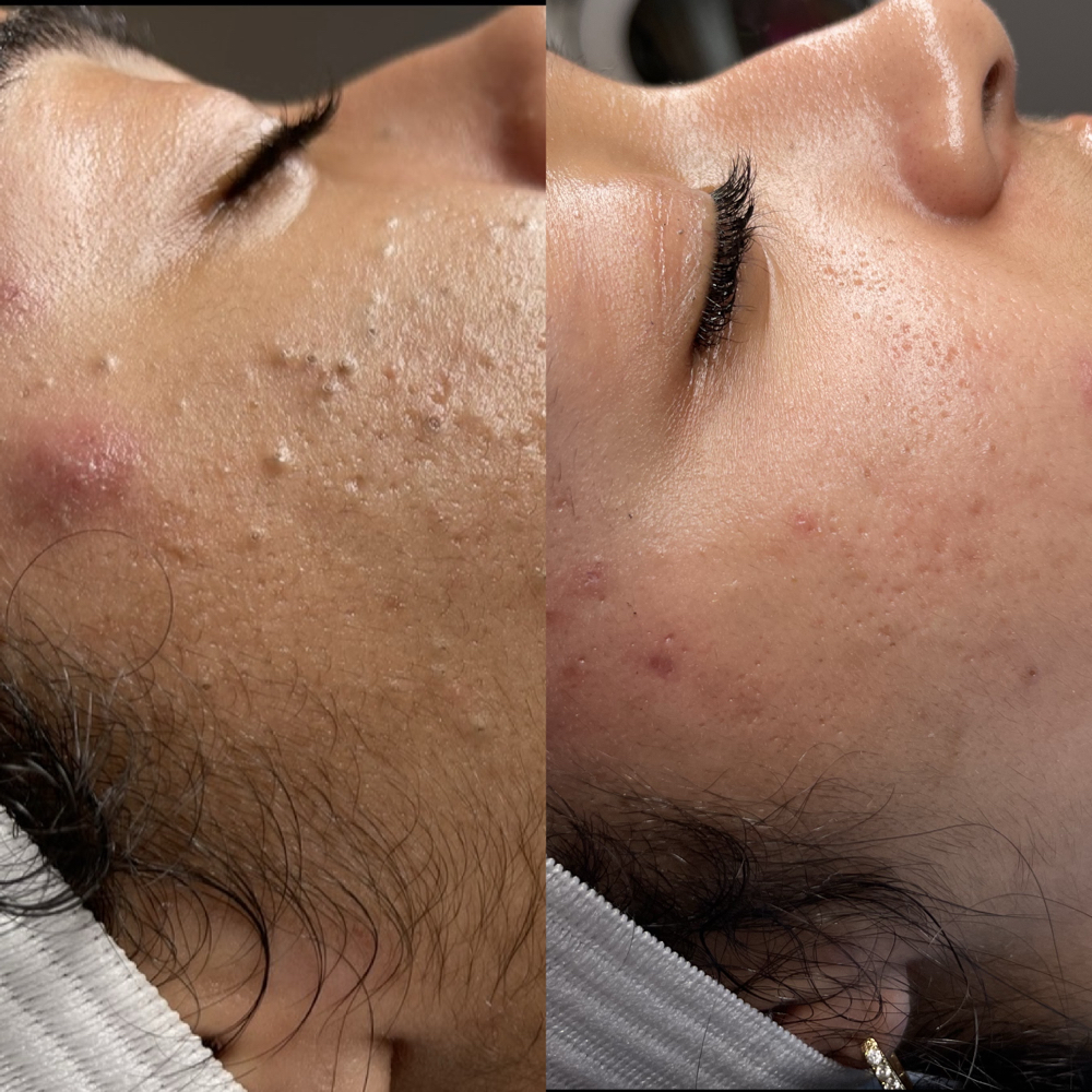 Face Reality Acne Bootcamp Facial