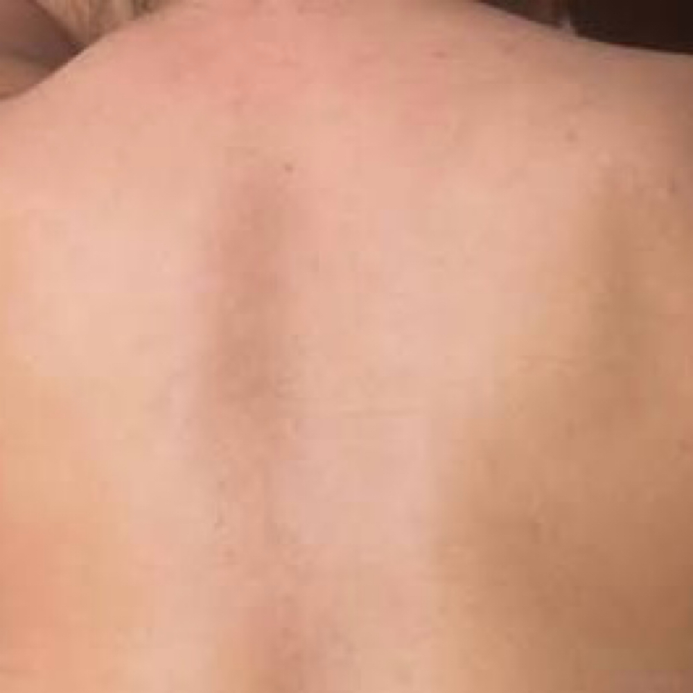 Upper Back at iSugar Waxing Studio in Redondo Beach, CA