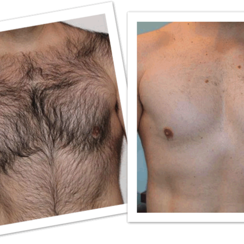 Laser Hair Reduction XL larea at The Laser Collective in Gilbert, AZ
