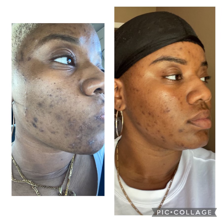 Express Chemical Peel