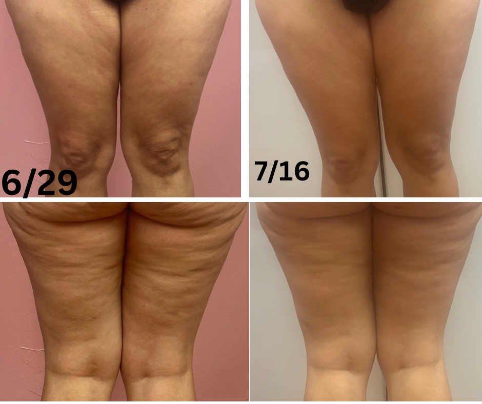 Cellulite Treatment at Get Waisted By MJ in Marietta, GA