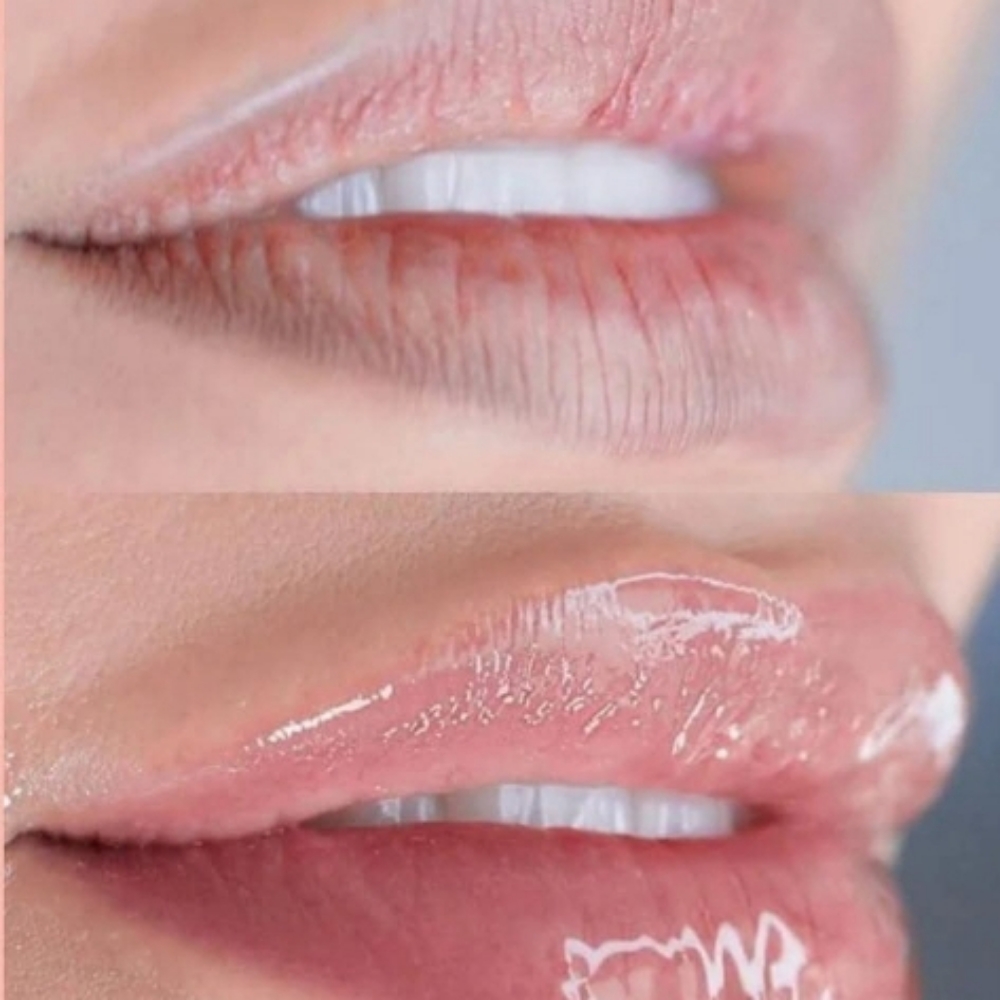 HydraGloss Lips at DayDream Esthetics Studio in Madison, IN