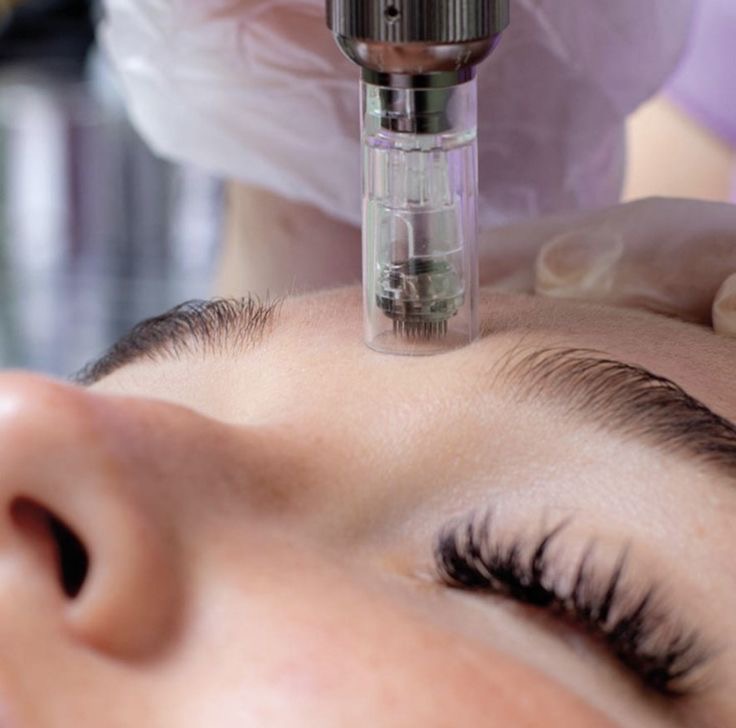 Microneedle Facial