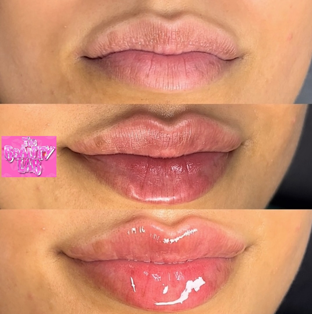 Half Syringe at The Beauty Lab DFW in Fort Worth, TX