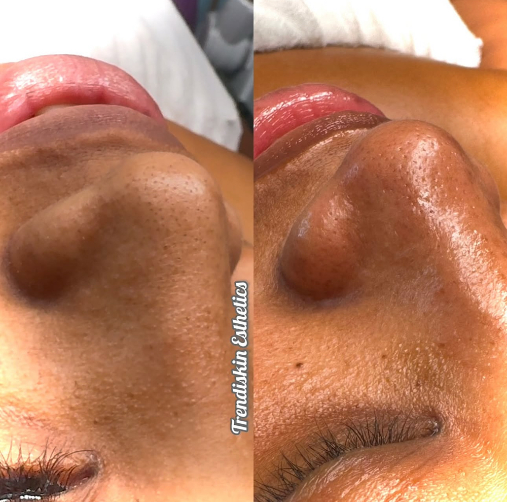 Ultimate Hydration Peels (2 Weeks)