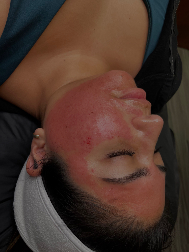 MICRO-NEEDLING
