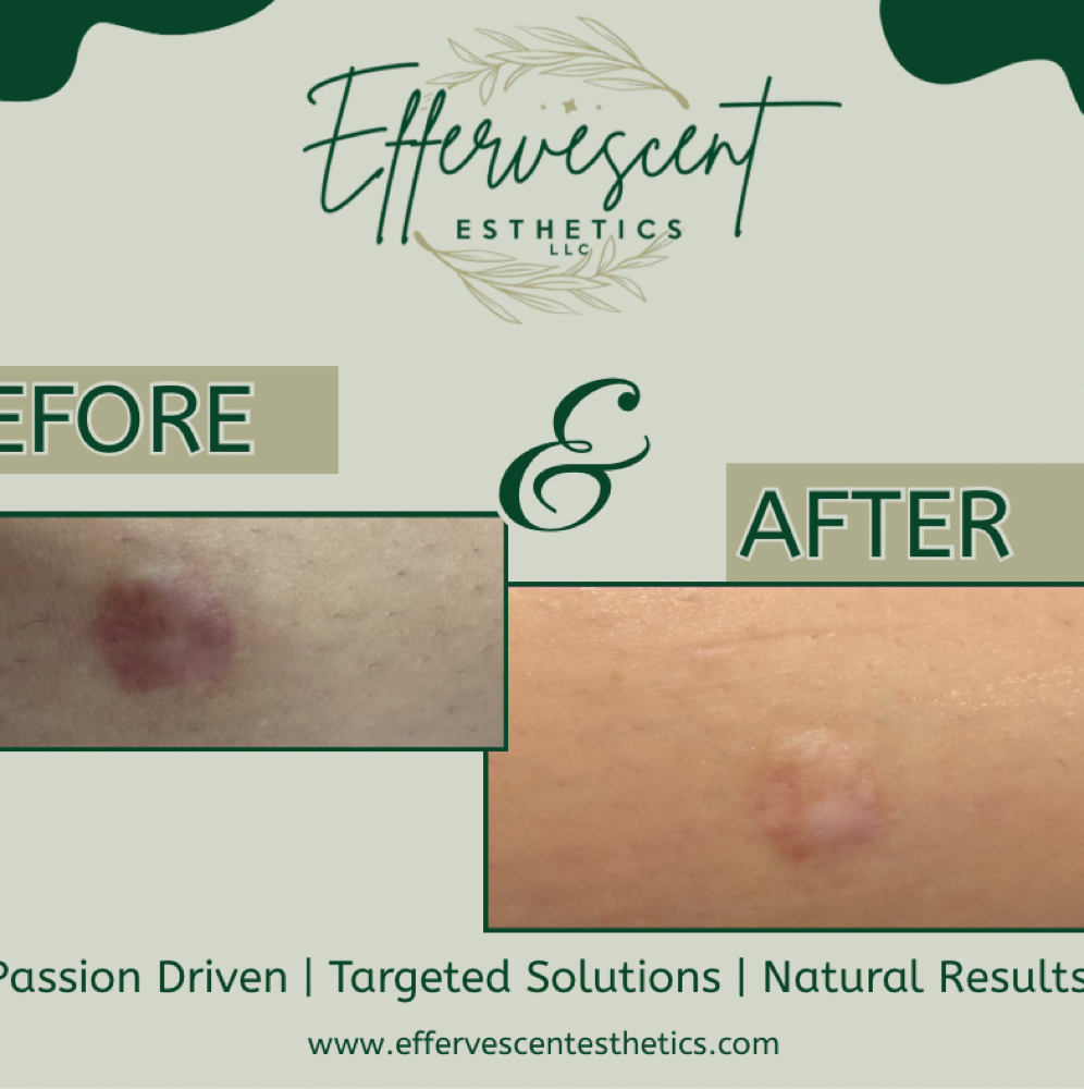 PRP Scar/Scars at Effervescent Esthetics in Freeport, IL
