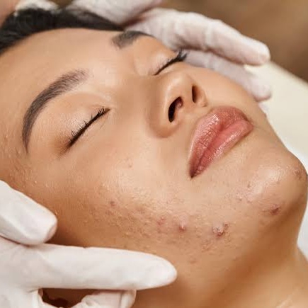 ProClear 30 at SkinFix Pro in Longwood, FL