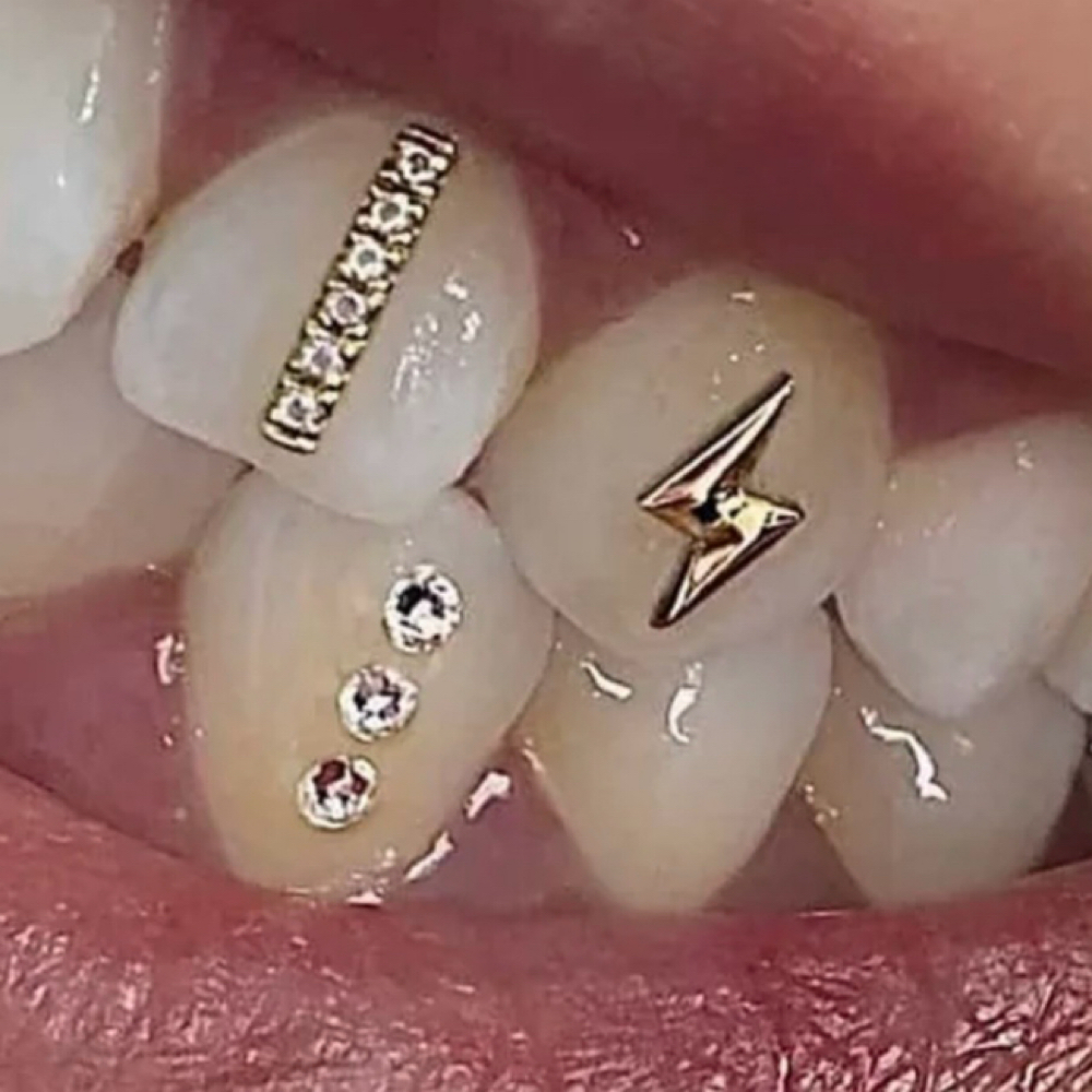 Single Gold Gem at Whitening Bliss✨🦷✨ in San Jose, CA