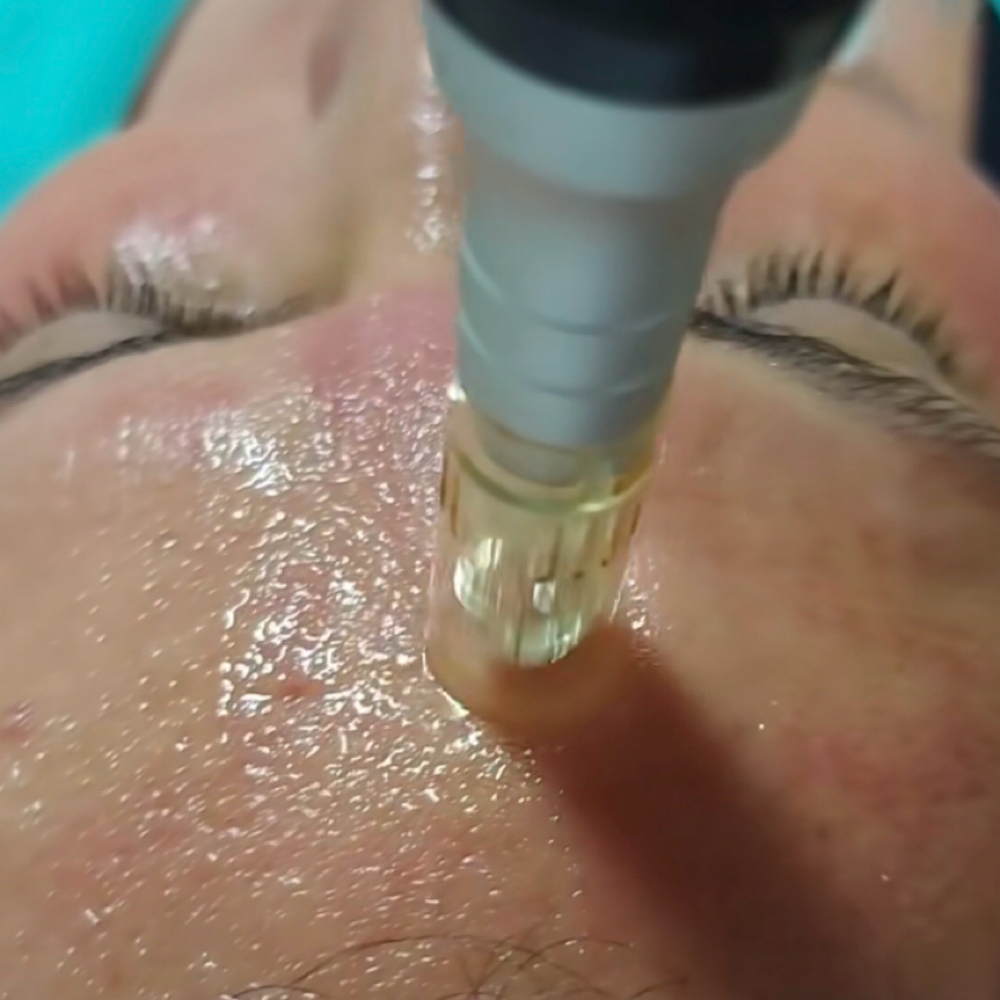 Microneedling/nanoinfusion at Glow With Beauty LLC in Bristol, CT