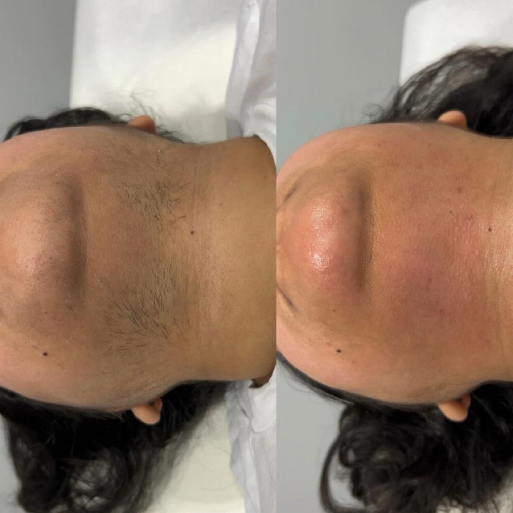 Chin Wax at Idaho Beauty Lounge in Eagle, ID