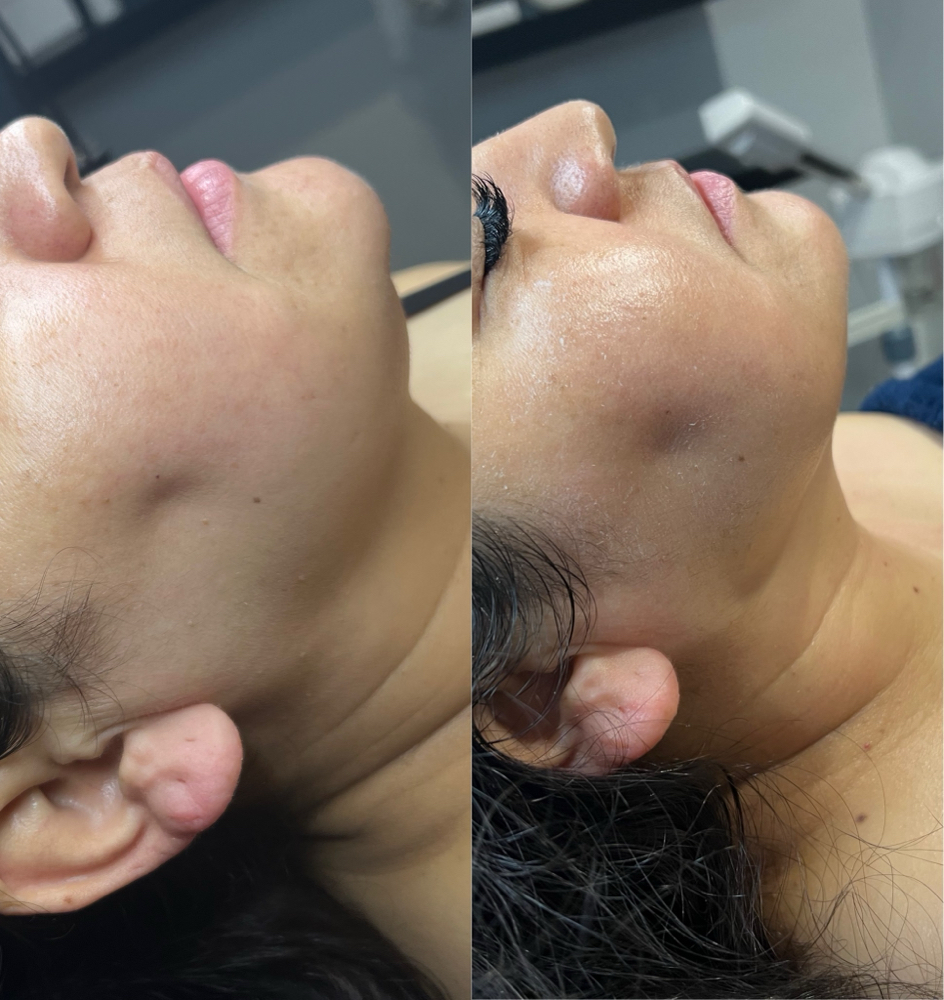 Under Chin Sculpting