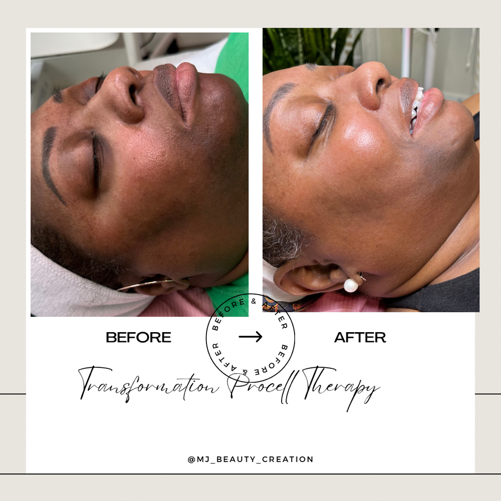 Microchanneling/ Microneedleling
