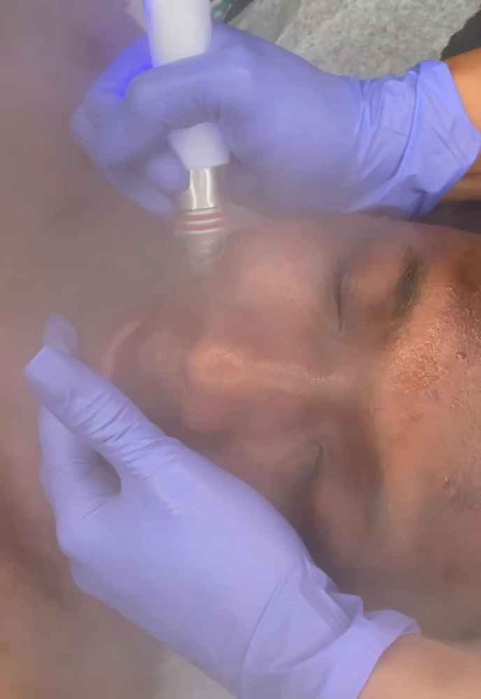 Microdermabrasion Facial