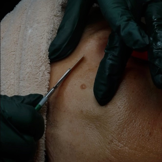 Dermaplane Mini Treatment at Alchemy Aesthetics in University Place, WA