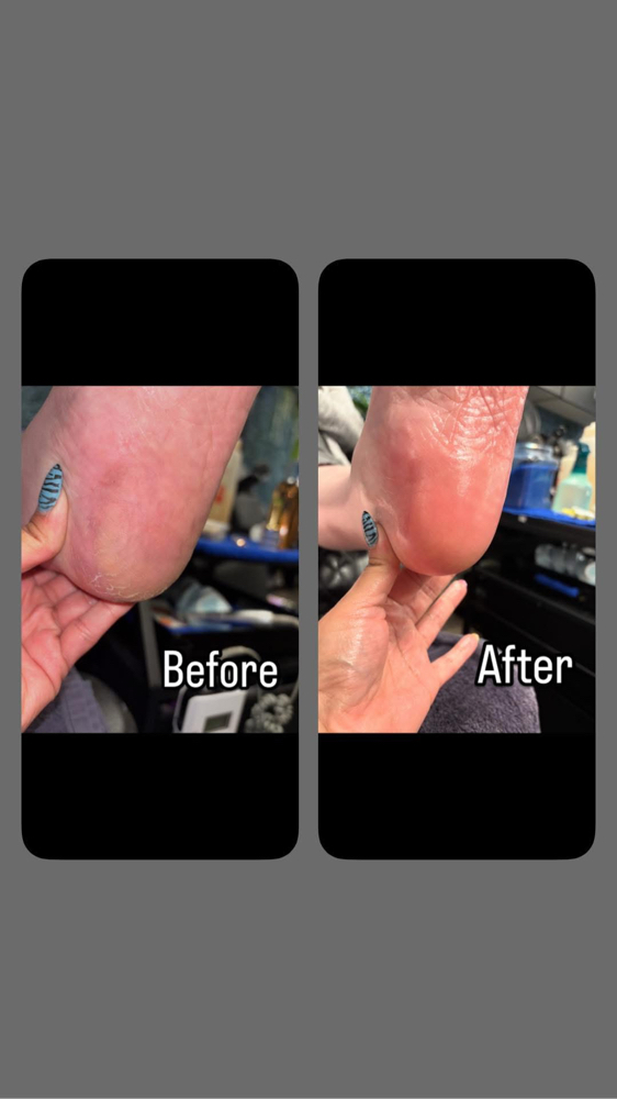 Express Callus Treatment
