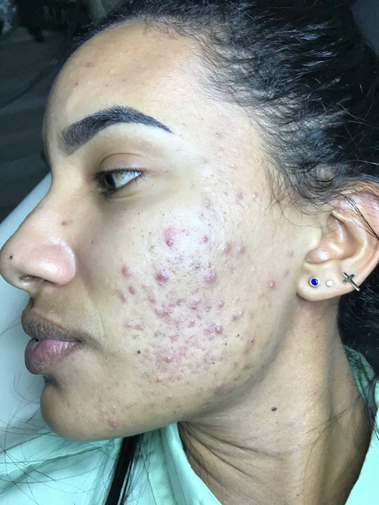 Acne Detox Clarify at Acnessia Laser Clinic in Guaynabo, PR