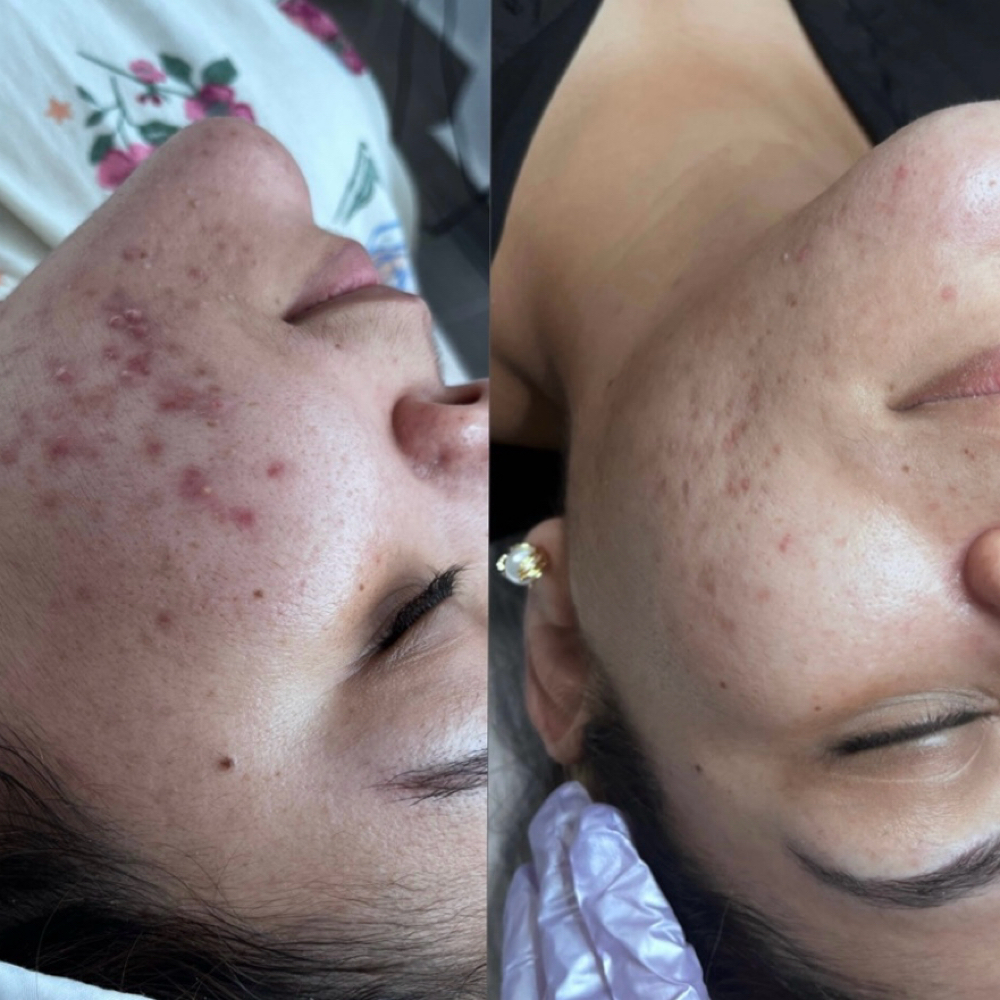 Acne Detox Clarify at Acnessia Laser Clinic in Guaynabo, PR