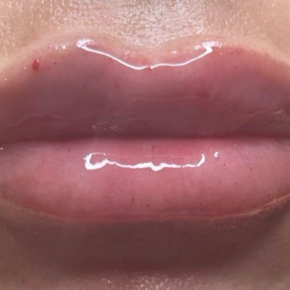 Lip Filler 1ML Juvederm at Pure Bliss Studios in Fort worth, TX