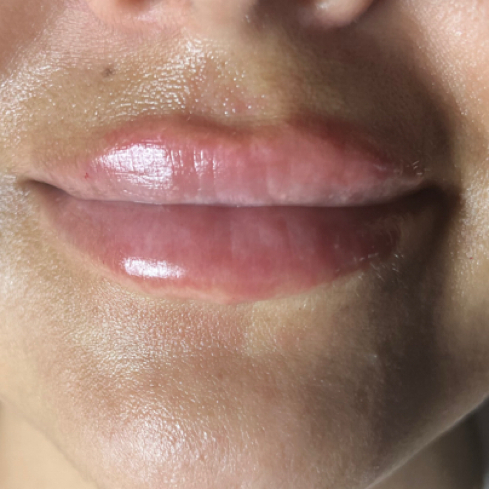 Lip Filler 1ML Juvederm at Pure Bliss Studios in Fort worth, TX
