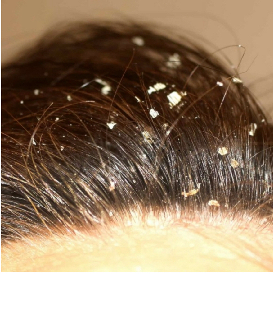 Scalp Treatment Detoxification