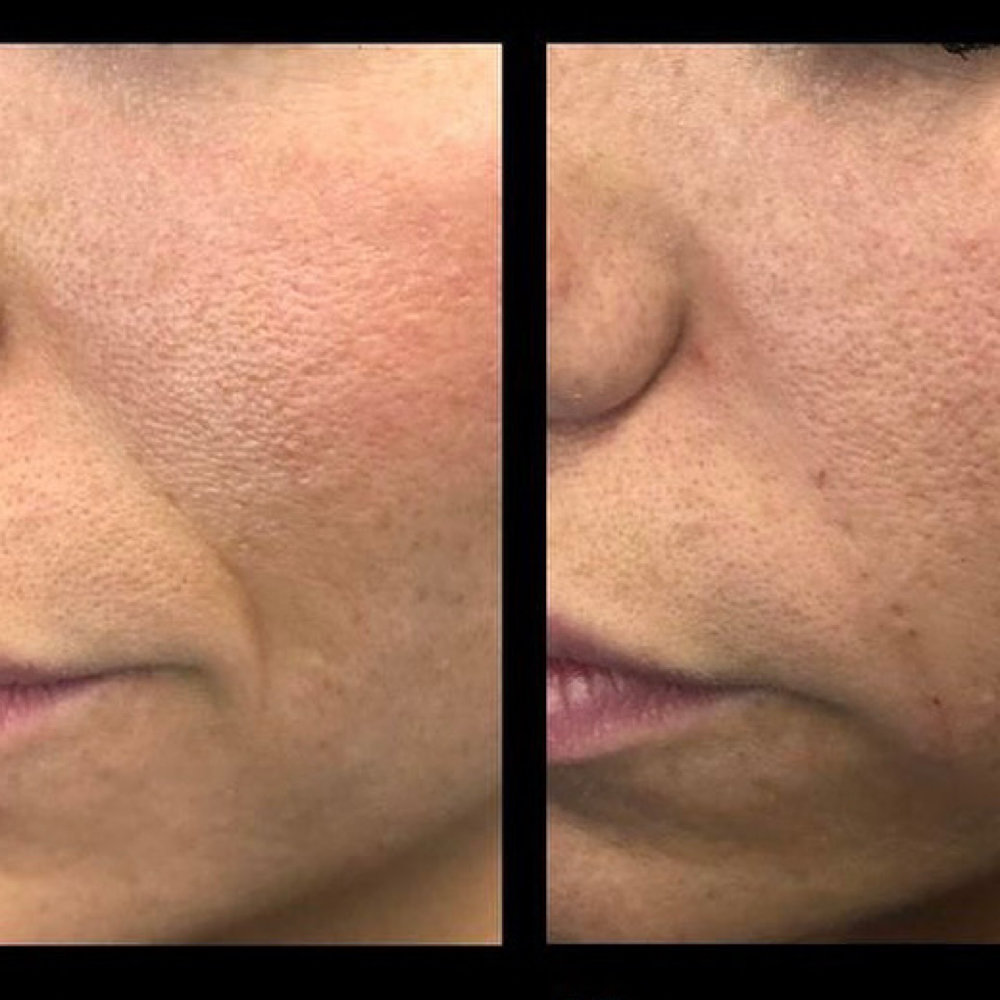 Nasolabial Fold Fillers at Glo’s Beauty Creations