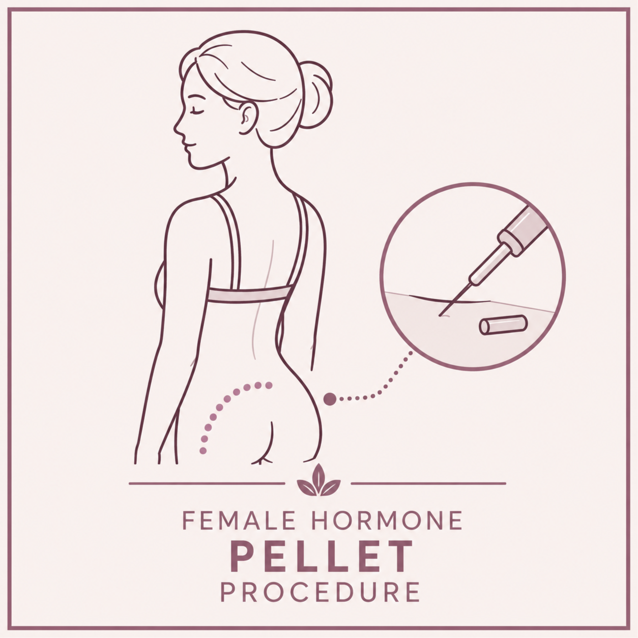 Female Hormone Pellet Procedure at Perrenia Wellness in Shallotte, NC
