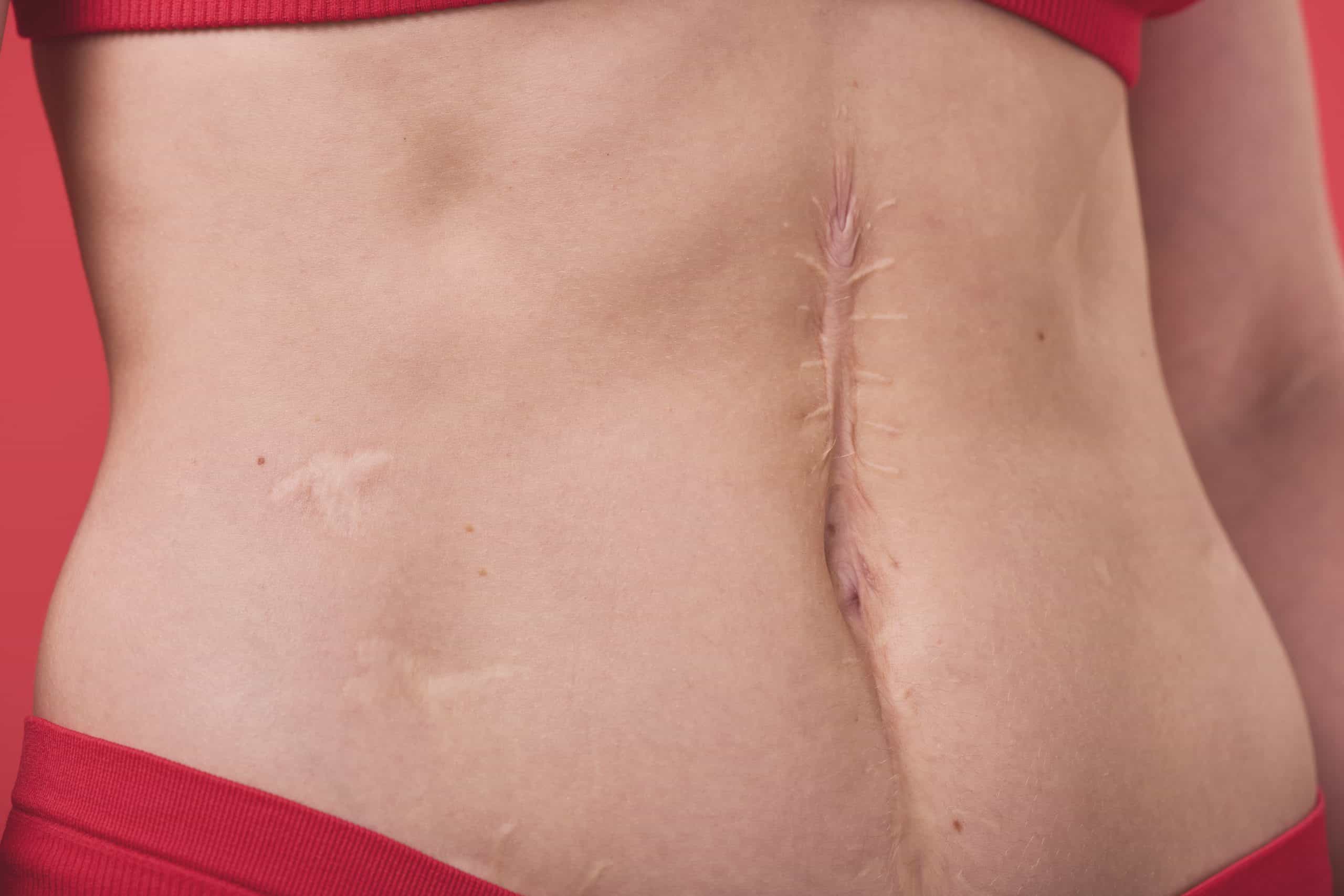 Scar Therapy