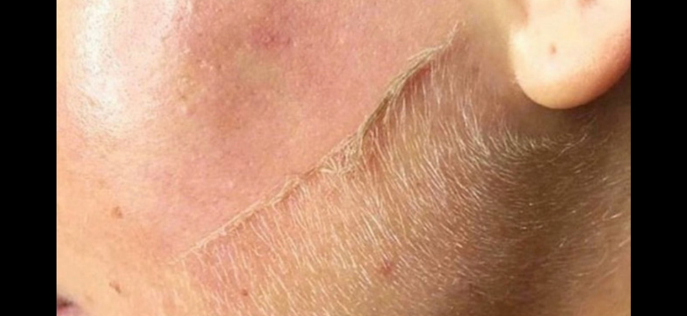 Dermaplaning Facial