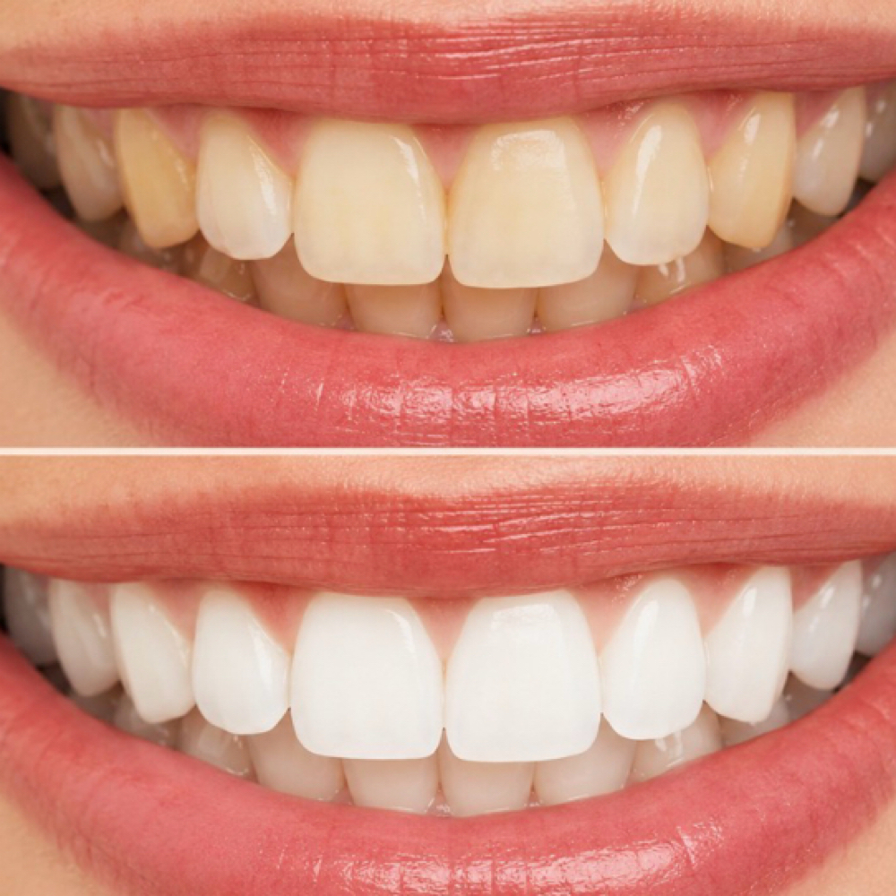 Teeth Whitening at Elevate RN Aesthetics in Mcallen, TX