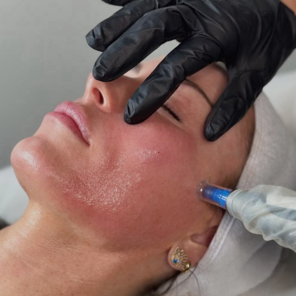 Microneedling Skin Renewal at The Glow Lab Aesthetics in Westbrook, ME