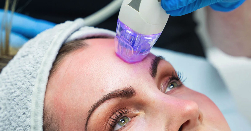 Radiofrequency Microneedling