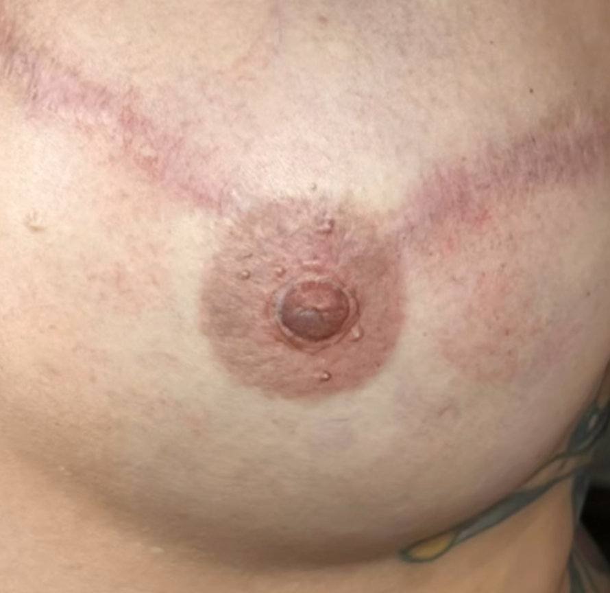 3D Areola Tattoo (Unilateral)