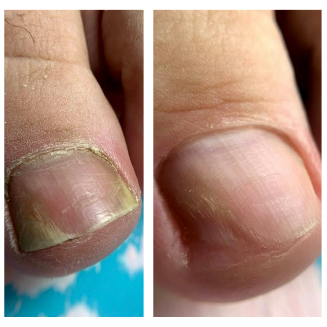 Toe Nail Repair (Per Nail)