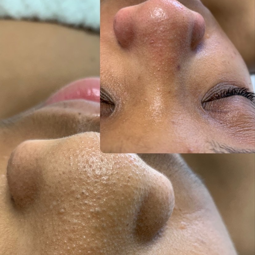 Fresh Start Teen Facial at Velnaira in Lakewood, CA