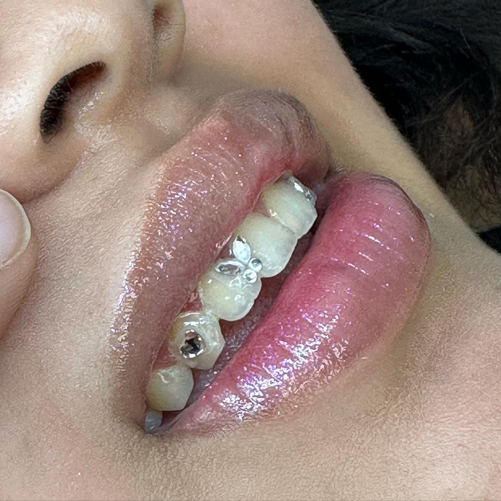 Tooth Gems