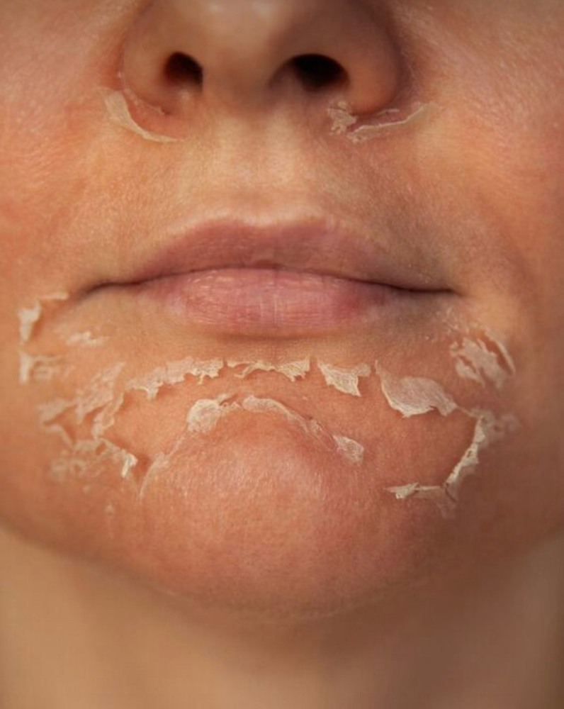MandeliClear w/Vitamin A Peel