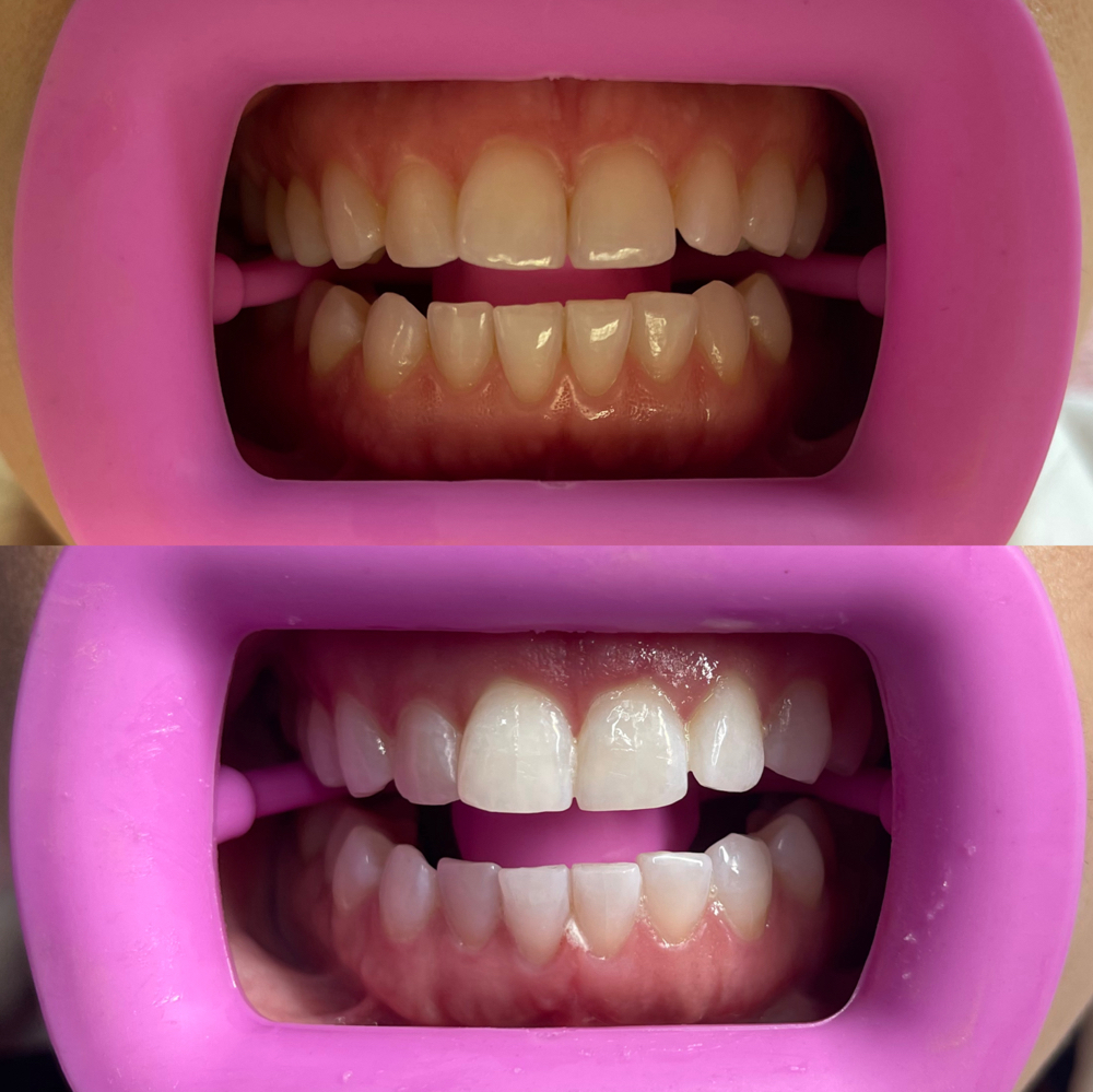 Cosmetic Teeth Whitening (Touch Up)