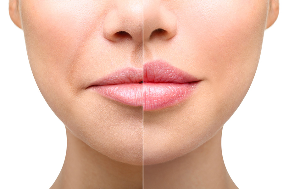 Lip Fillers