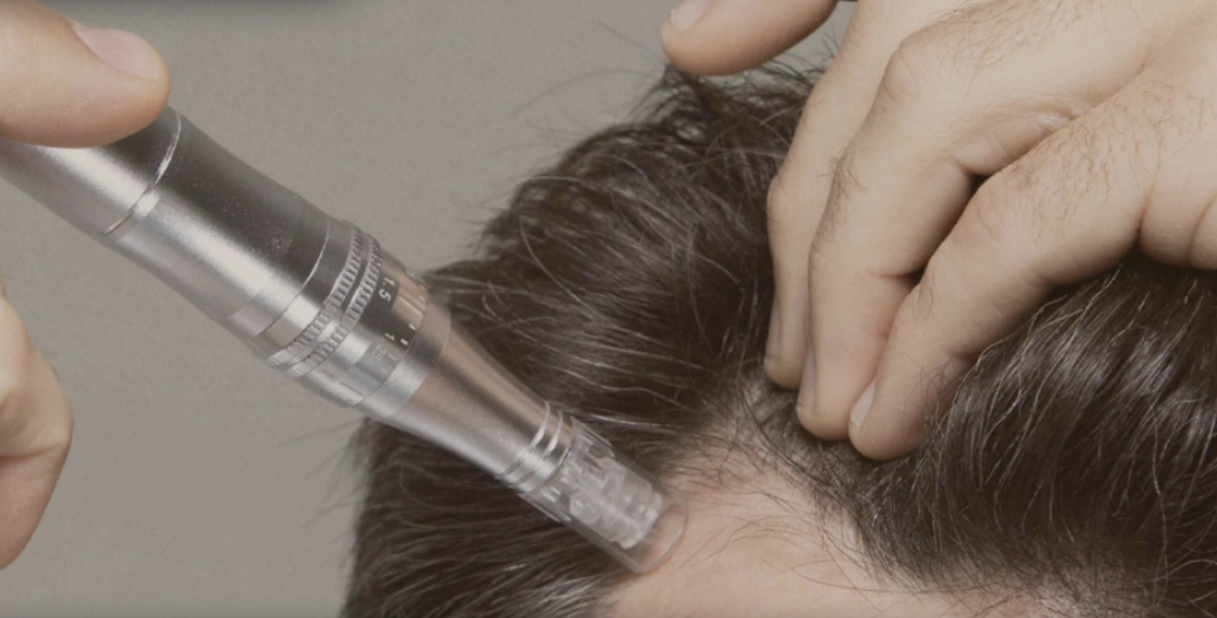 Microneedling with PRP (hair/scalp)