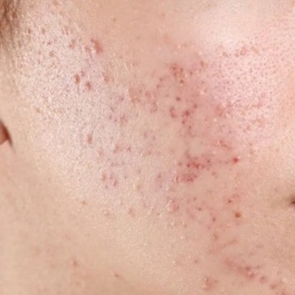 Standard Acne Facial at The Hidden Trough Aesthetics in Aiken, SC