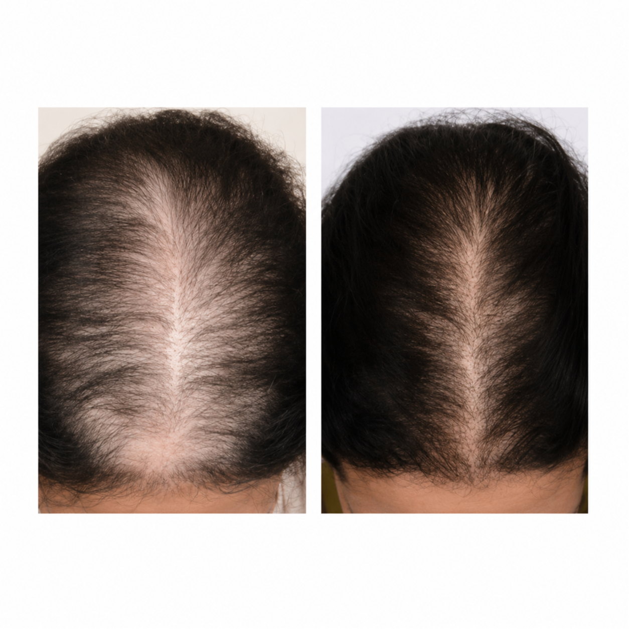 SERA HB Hair Restoration at Skin Corrective Aesthetics in Dallas, TX